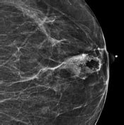 Breast Calcifications Radiology Reference Article Radiopaedia Org