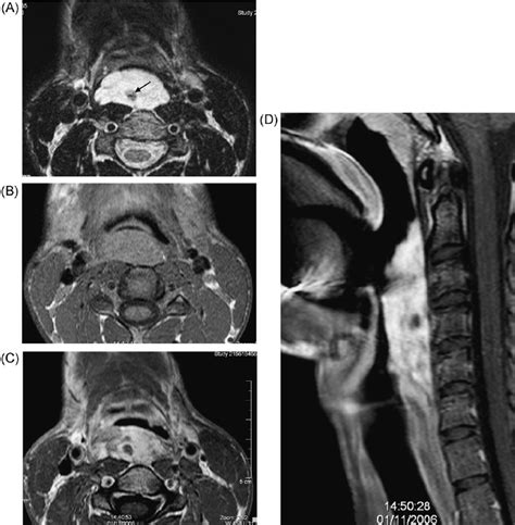 Hemangioma Of Adult Type Venous Malformation A Axial T2 Weighted Download Scientific