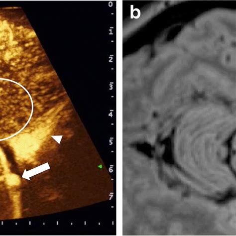 Contrast Enhanced Ultrasound Ceus Quantification Methods Bolus Based