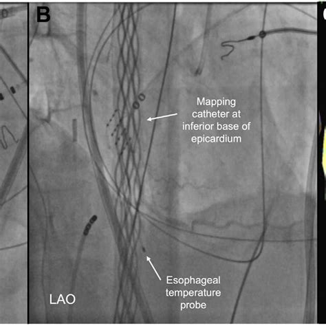 Intraprocedural Fluoroscopy Images And 3 Dimensional Electroanatomic