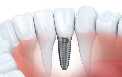 Dental Implants In Woodland Hills CA Biosafe Cosmetic Dentistry