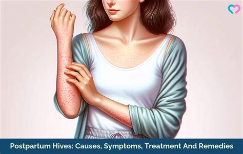 Postpartum Hives Causes Symptoms Treatment And Remedies