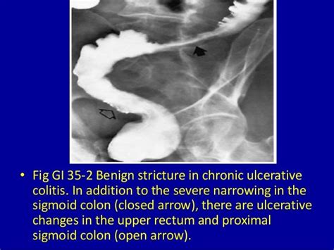 35 Narrowing Of The Colon