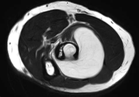 A Case Of Intraosseous Lipoma With Intermuscular Extension Eurorad