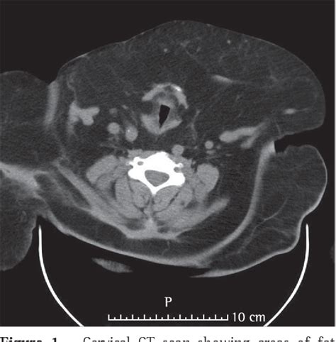 Figure 1 from Madelung's disease as a rare cause of obstructive sleep apnea. | Semantic Scholar