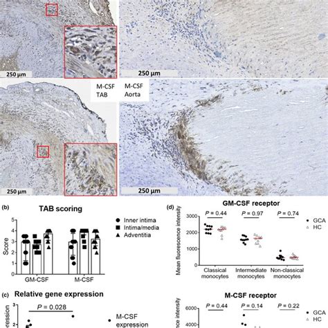 Gmcsf And Mcsf Signalling In Gca Tissues Macrophages And Monocyte