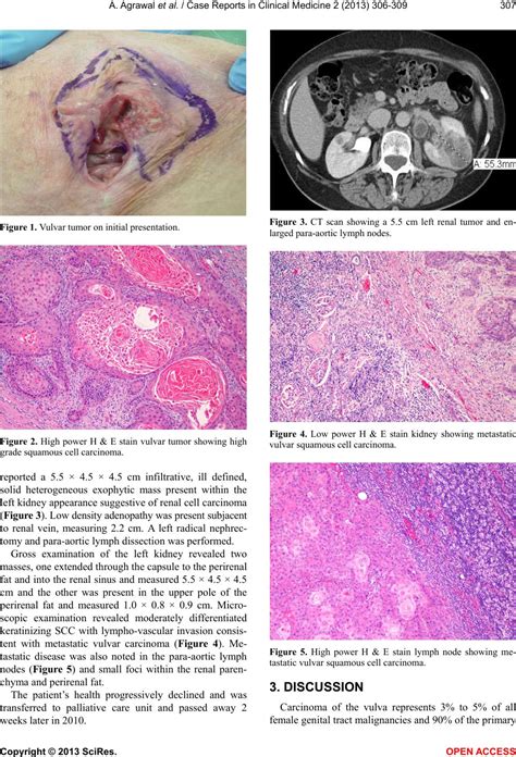 Vulvar Squamous Cell Carcinoma