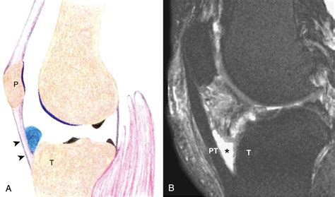 Deep Infrapatellar Bursa Injection Clinical Tree