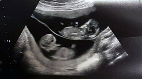 Twin Ultrasound 12 Weeks: Dating & Chorionicity Scan – About Twins