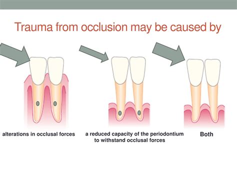 Ppt Managing Trauma From Occlusion In Dental Therapy Powerpoint