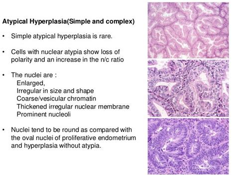 Endometrial hyperplasia