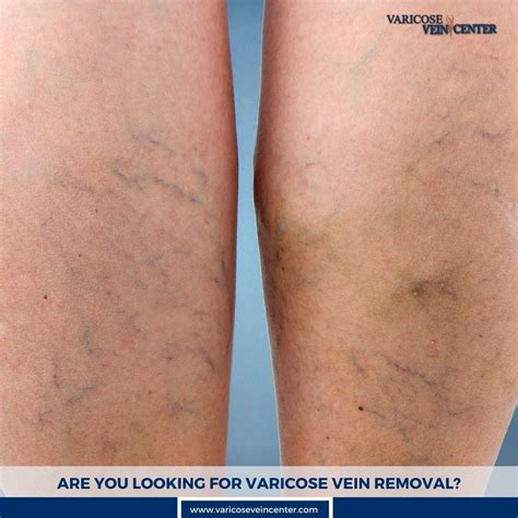 Varicose Vein Removal — Port Jefferson Ny By Varicose Vein Center Jun 2024 Medium