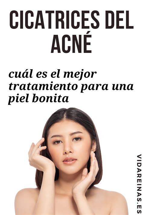 Cicatrices Del Acné ¿cuál Es El Mejor Tratamiento Para Una Piel Bonita