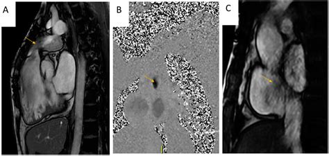 J Imaging Free Full Text Multimodality Imaging Of The Neglected Valve Role Of