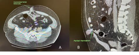 Figure 1 From A Novel Laparoscopic Non Resective Technique For The