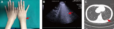 Case 1 A Physical Examination Showed Right Wrist Swelling Arrow B Download Scientific