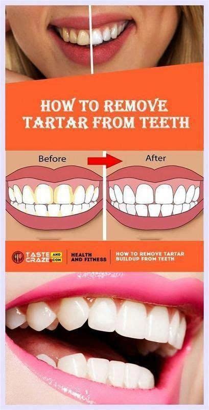 Get Rid Of Cavities And Tooth Decay Brenda Benjamin Artofit