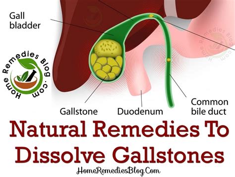 10 Best Home Remedies For Gallstones Treatment With Diet Plan Home Remedies Blog