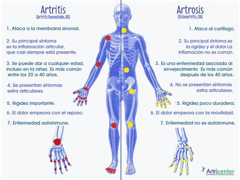 Recomendaciones Para La Artritis Y La Artrosis