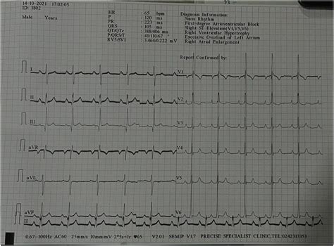 Ecg Of The Patient Showing Regular Sinus Rhythm With Right Atrial