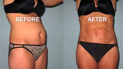 Real Liposuction Results And Before And After Testimonial Youtube