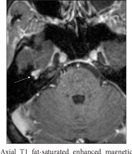 Figure From A Case Of A Facial Nerve Venous Malformation Presenting