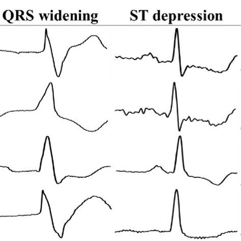 The Patterns Of Qrs Widening Sinus Rhythm St Depression And St Download Scientific Diagram