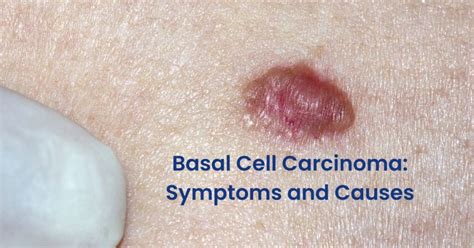 Basal Cell Carcinoma: Symptoms and Causes - Pi Health Cancer Hospital 