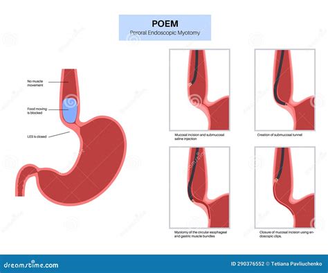 POEM medical poster stock illustration. Illustration of gastroesophageal - 290376552