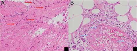 Histologic images taken from the ileocolic resection. (A)... | Download Scientific Diagram