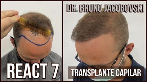 React Transplante Dutasterida Dr Bruno Jacobovski Youtube