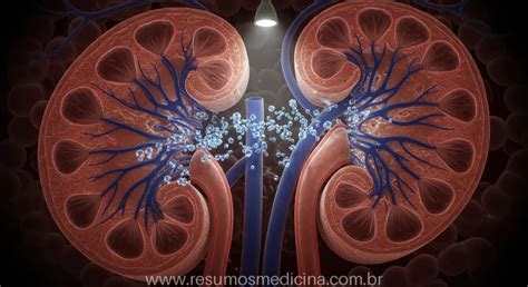 O Que É Nefropatia Grave - Nefropatia Induzida por Contraste (NIC): Guia Definitivo de Prevenção ...