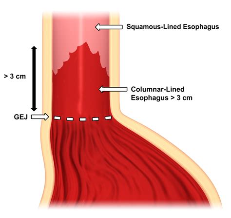 ArtStation - Barrett's Esophagus Diagrams
