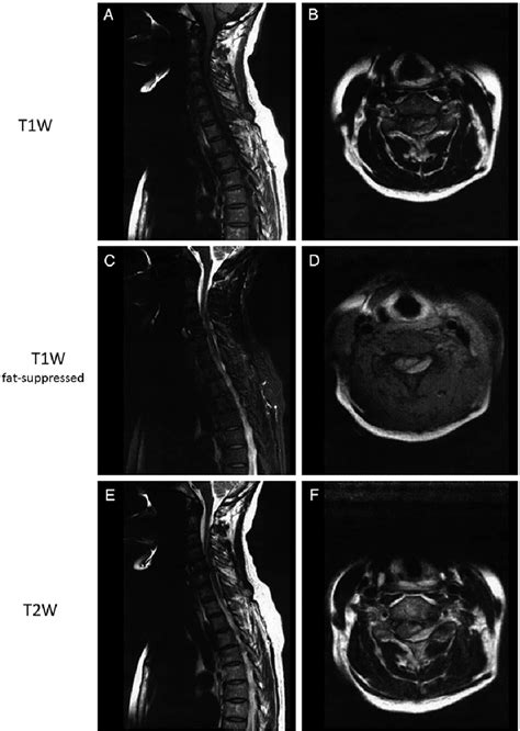 Figure 1 From Cervical Epidural Hematoma In A Healthy Donor Presenting