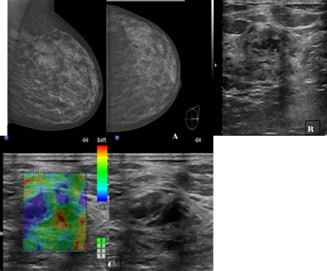 year  woman complaining  bilateral mastalgia mammogram