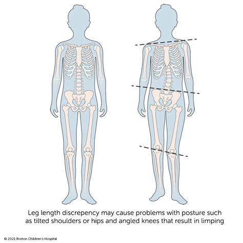 Limb Length Discrepancy | Boston Children's Hospital