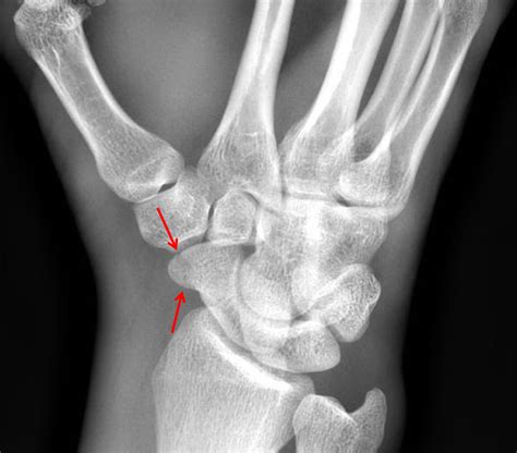 Scaphoid bone fracture - christmasjoker