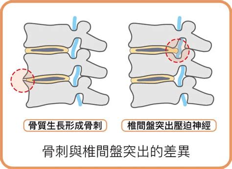 顧脊椎 瞭解骨刺與椎間盤突出 一定要開刀嗎？ 🍄樂愛生活手札