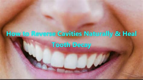 How To Reverse Cavities Naturally Heal Tooth Decay YouTube