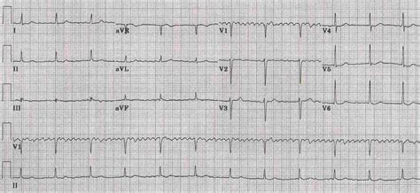 Ecg 5 Regularized Af Acilcinet