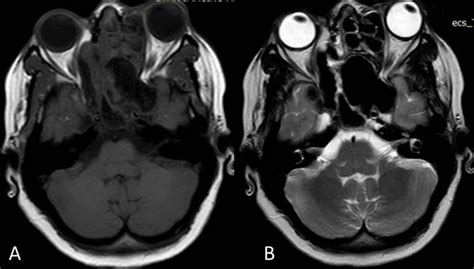 Double Density Sign In Fungal Sinusitis Heterogeneous Areas Of Signal