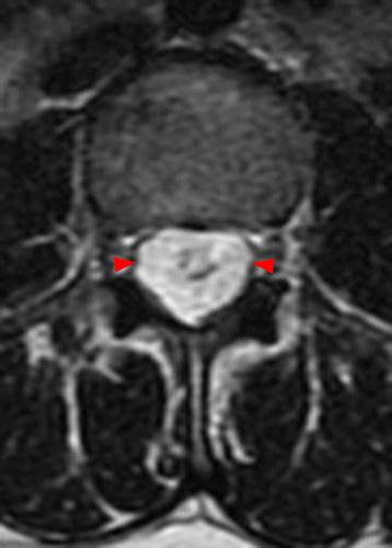 Myxopapillary Ependymoma | Radsource