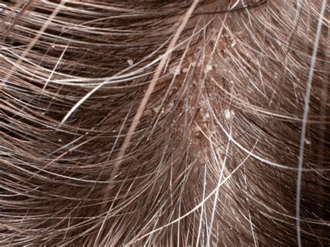 Eyebrow Dandruff Guide Causes Treatments RemoteDerm