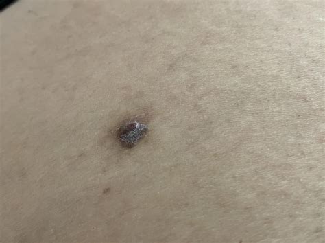 Is this Keratosis? : r/keratosis