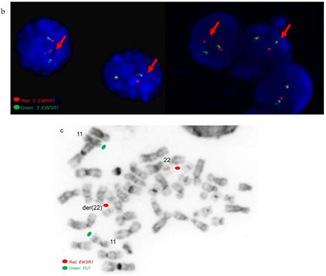 Genes Free Full Text Complexcryptic Ewsr1fli1erg Gene Fusions