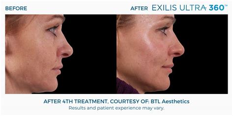 Exilis Ultra El Paso Exilis Skin Tightening Treatments