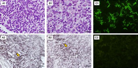 Anti Gabab Receptor Encephalitis Associated With Combined Small Cell Lung Carcinoma Journal Of