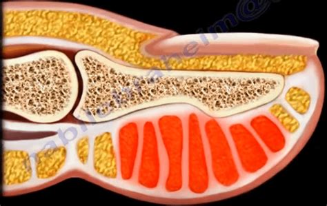 Felon - Bacteria Infections Orthopedics finger Healthcare