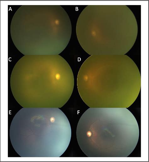 Figure 1 From Retinopathy Of Prematurity Screening Of Preterm Infants With Icteric Vitreous