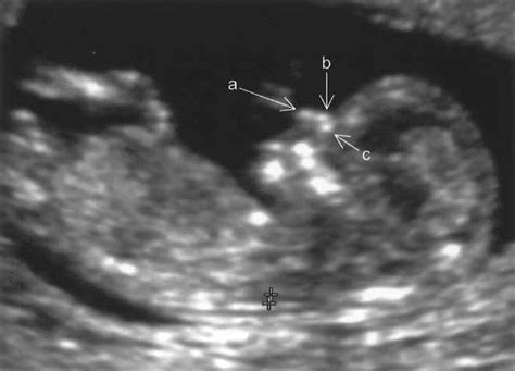 The Nasal Bone In Fetuses With Trisomy Sonographic Versus